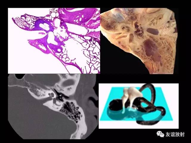 【PPT】颞骨影像解剖