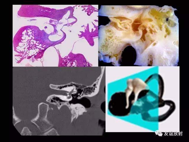 【PPT】颞骨影像解剖