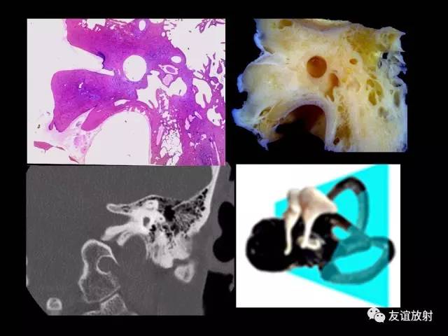 【PPT】颞骨影像解剖