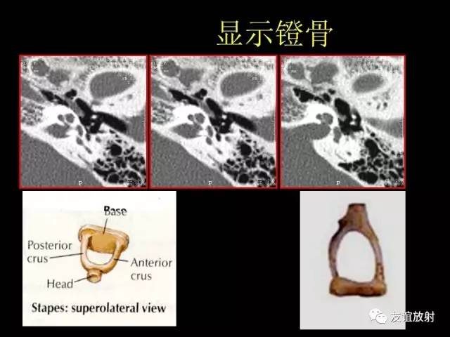 【PPT】颞骨影像解剖