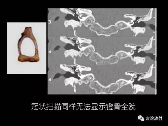 【PPT】颞骨影像解剖