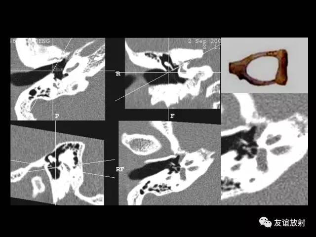 【PPT】颞骨影像解剖