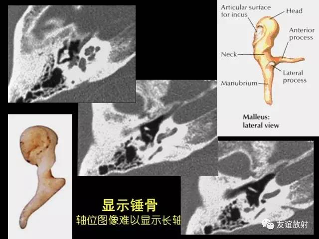【PPT】颞骨影像解剖