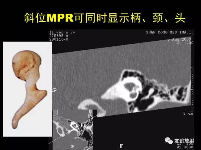 【PPT】颞骨影像解剖