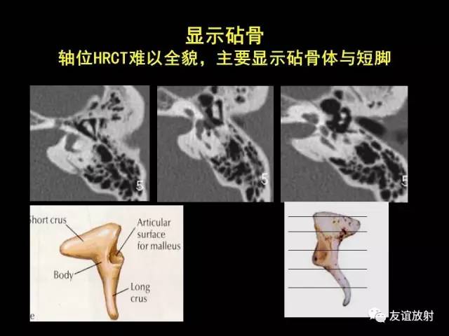 【PPT】颞骨影像解剖