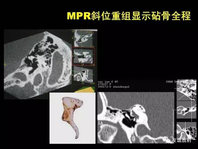 【PPT】颞骨影像解剖