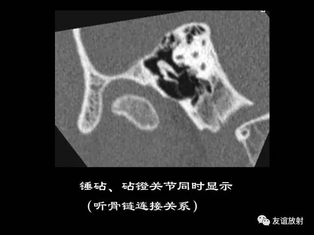 【PPT】颞骨影像解剖