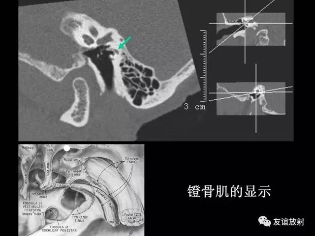 【PPT】颞骨影像解剖