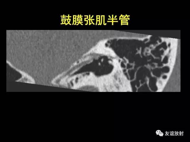【PPT】颞骨影像解剖