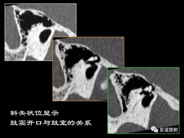 【PPT】颞骨影像解剖