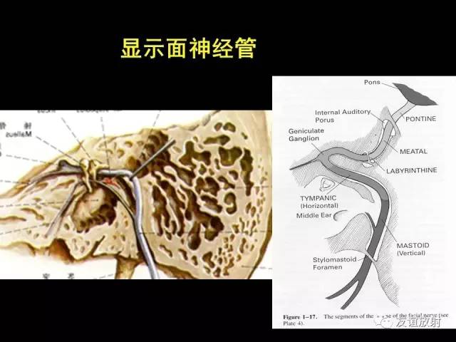 【PPT】颞骨影像解剖
