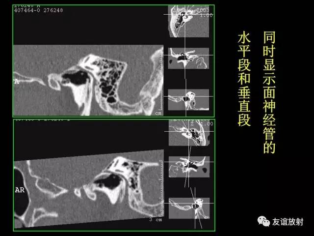 【PPT】颞骨影像解剖