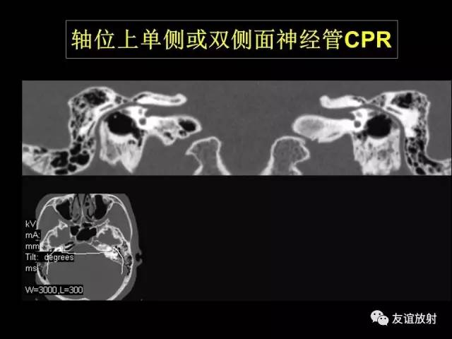 【PPT】颞骨影像解剖