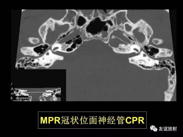 【PPT】颞骨影像解剖