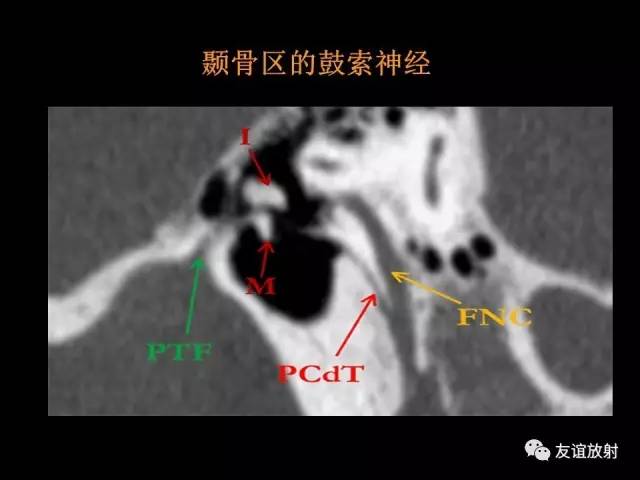 【PPT】颞骨影像解剖
