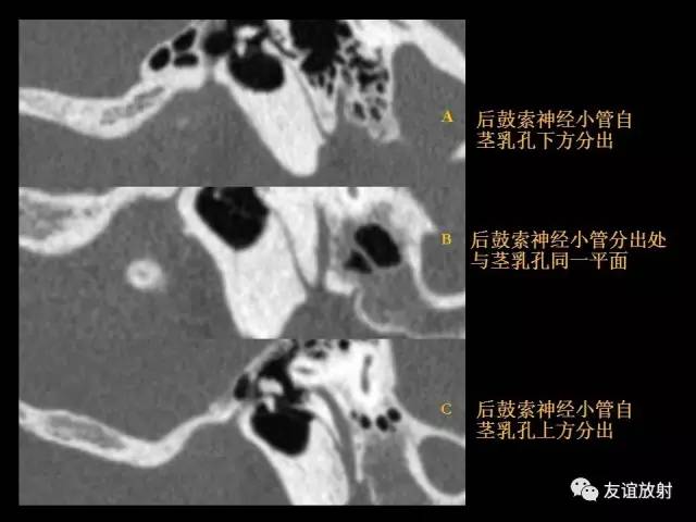 【PPT】颞骨影像解剖