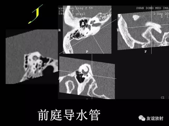 【PPT】颞骨影像解剖