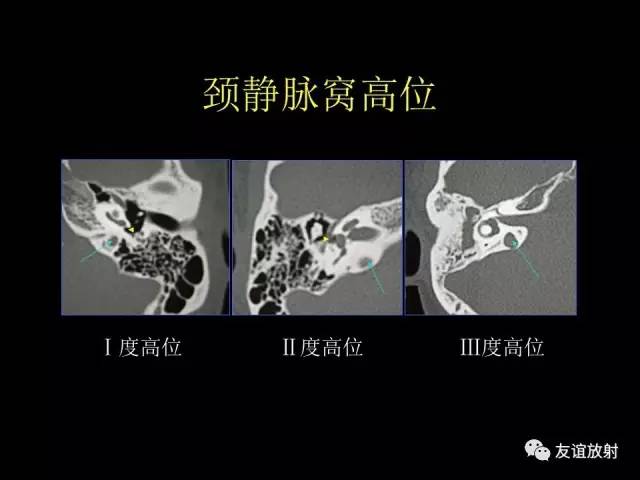 【PPT】颞骨影像解剖
