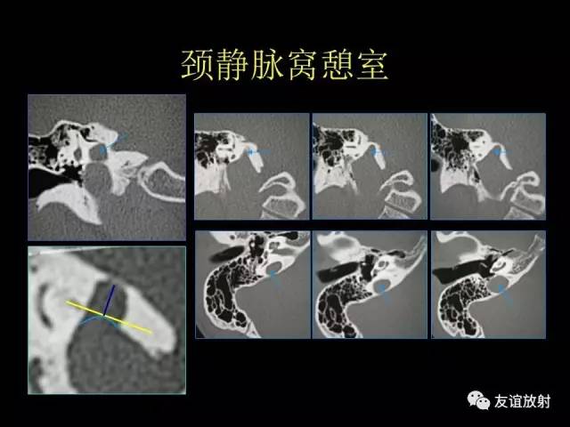 【PPT】颞骨影像解剖