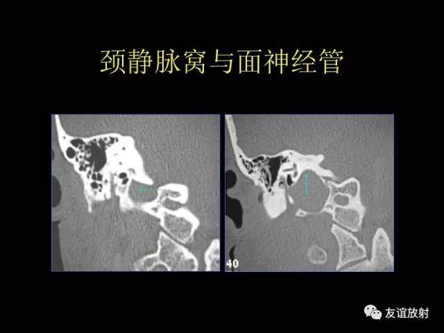 【PPT】颞骨影像解剖