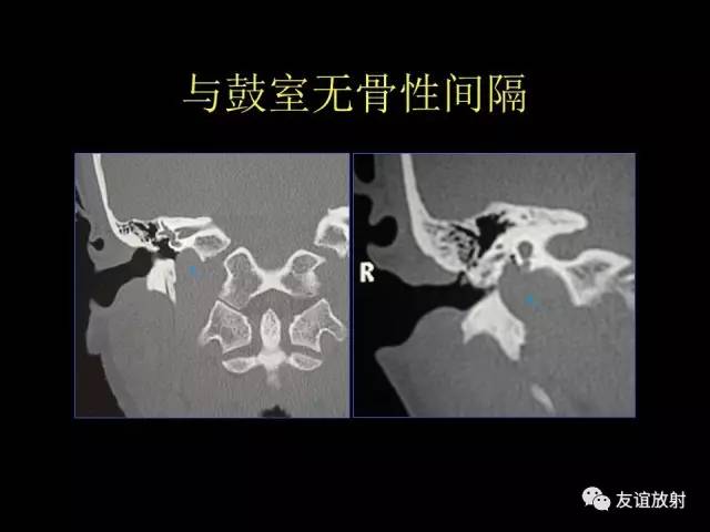 【PPT】颞骨影像解剖