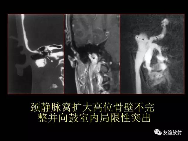 【PPT】颞骨影像解剖