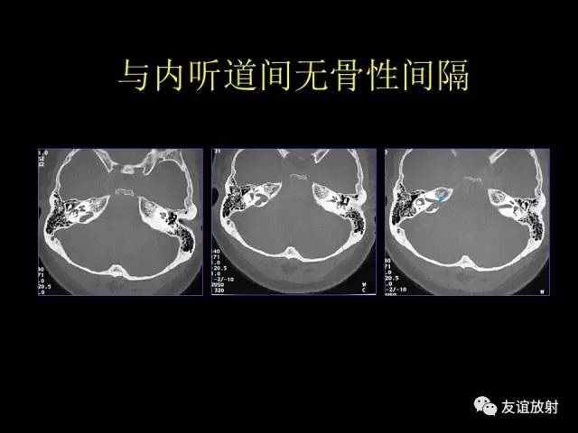 【PPT】颞骨影像解剖