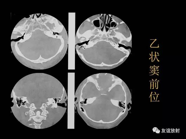 【PPT】颞骨影像解剖
