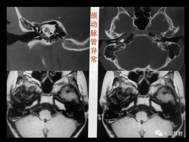 【PPT】颞骨影像解剖