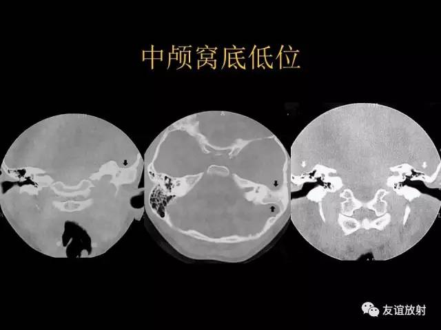 【PPT】颞骨影像解剖