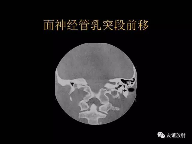 【PPT】颞骨影像解剖