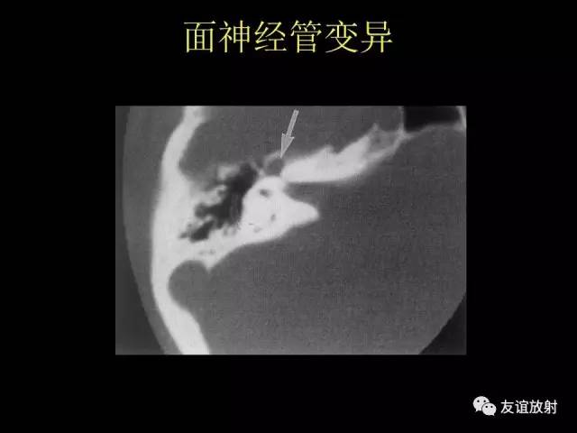 【PPT】颞骨影像解剖