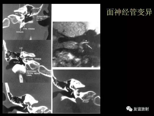 【PPT】颞骨影像解剖