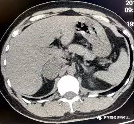 【病例】右肾上腺节细胞神经瘤1例CT影像表现