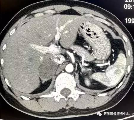 【病例】右肾上腺节细胞神经瘤1例CT影像表现