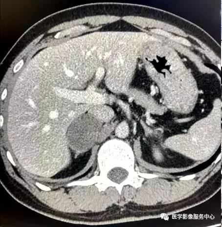 【病例】右肾上腺节细胞神经瘤1例CT影像表现