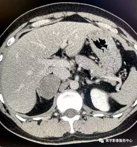 【病例】右肾上腺节细胞神经瘤1例CT影像表现