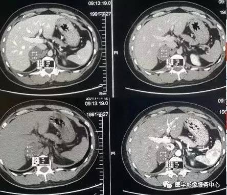 【病例】右肾上腺节细胞神经瘤1例CT影像表现