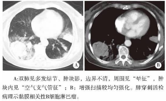 原发性肺淋巴瘤