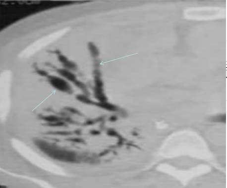 原发性肺淋巴瘤