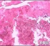 【病例】骨转移瘤1例X线MR影像表现