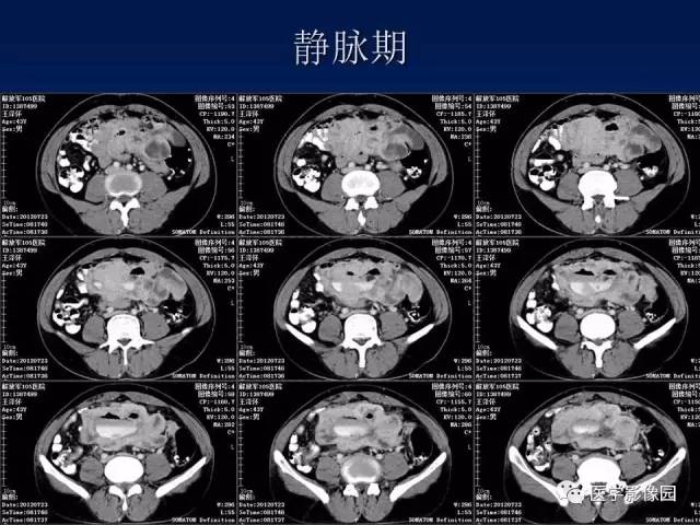 【病例】小肠间质瘤1例CT影像表现 【病例】小肠间质瘤1例CT影像表现