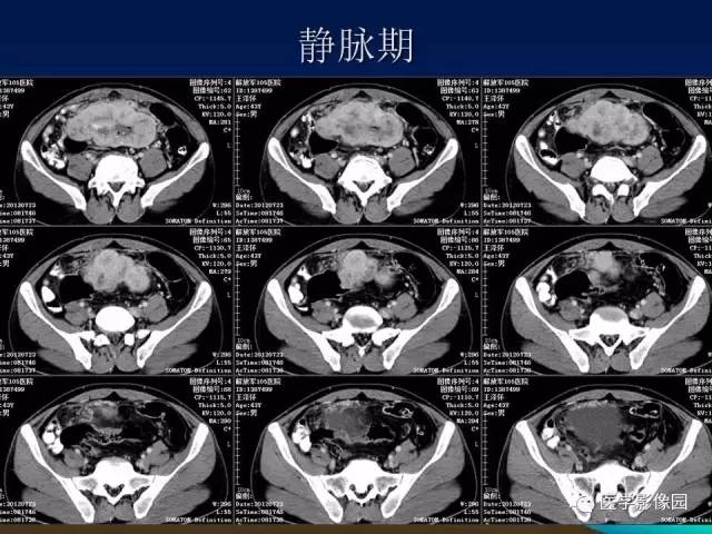【病例】小肠间质瘤1例CT影像表现 【病例】小肠间质瘤1例CT影像表现