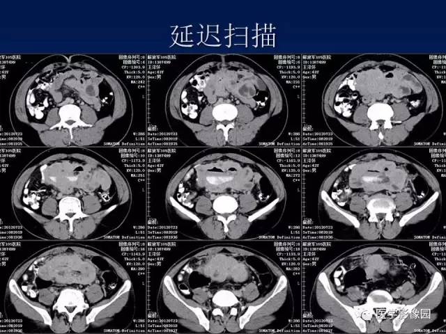 【病例】小肠间质瘤1例CT影像表现 【病例】小肠间质瘤1例CT影像表现