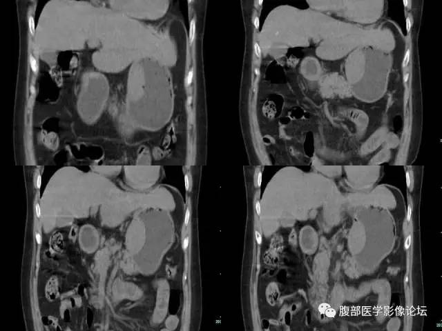 【病例】(胃体)胃肠道间质瘤1例CT影像表现