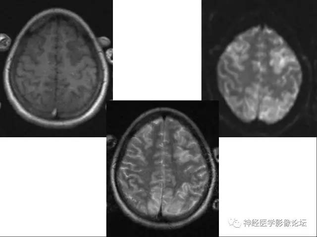 【病例】急性间歇性血卟啉病(吸血鬼症)1例MR