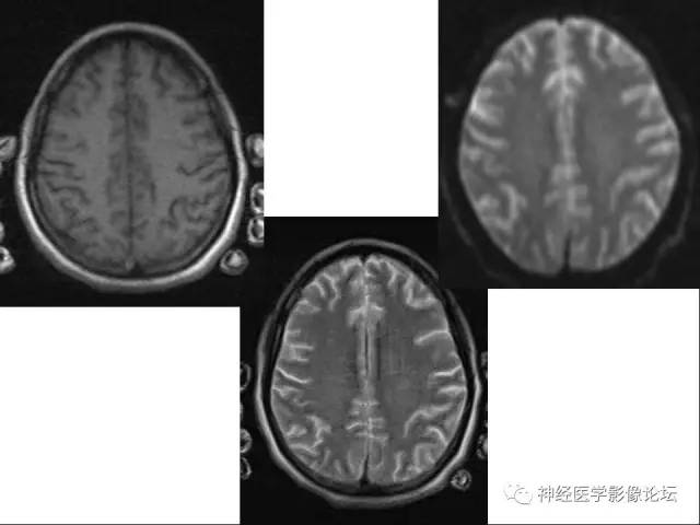 【病例】急性间歇性血卟啉病(吸血鬼症)1例MR