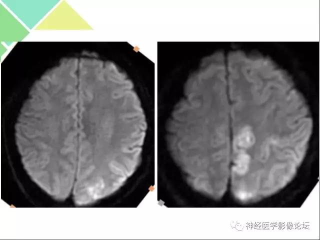 【病例】急性间歇性血卟啉病(吸血鬼症)1例MR