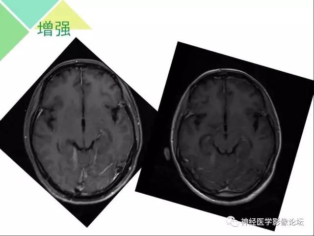 【病例】急性间歇性血卟啉病(吸血鬼症)1例MR