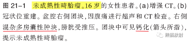 卵巢恶性生殖细胞瘤的CT和MRI表现